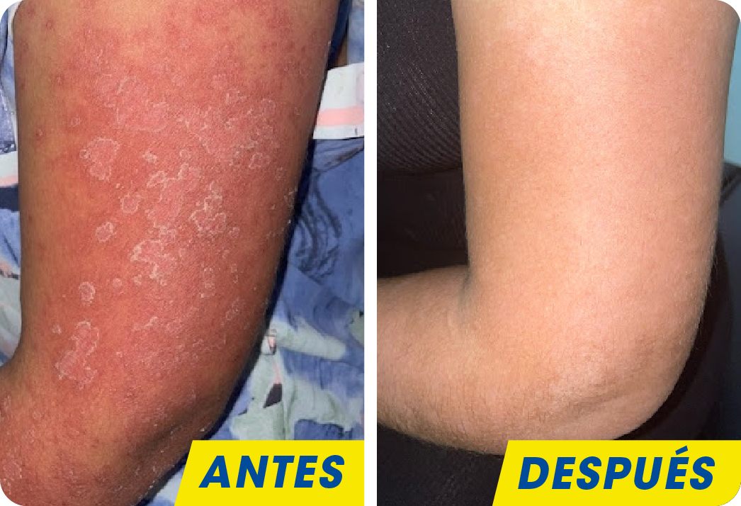 PSORIASIS