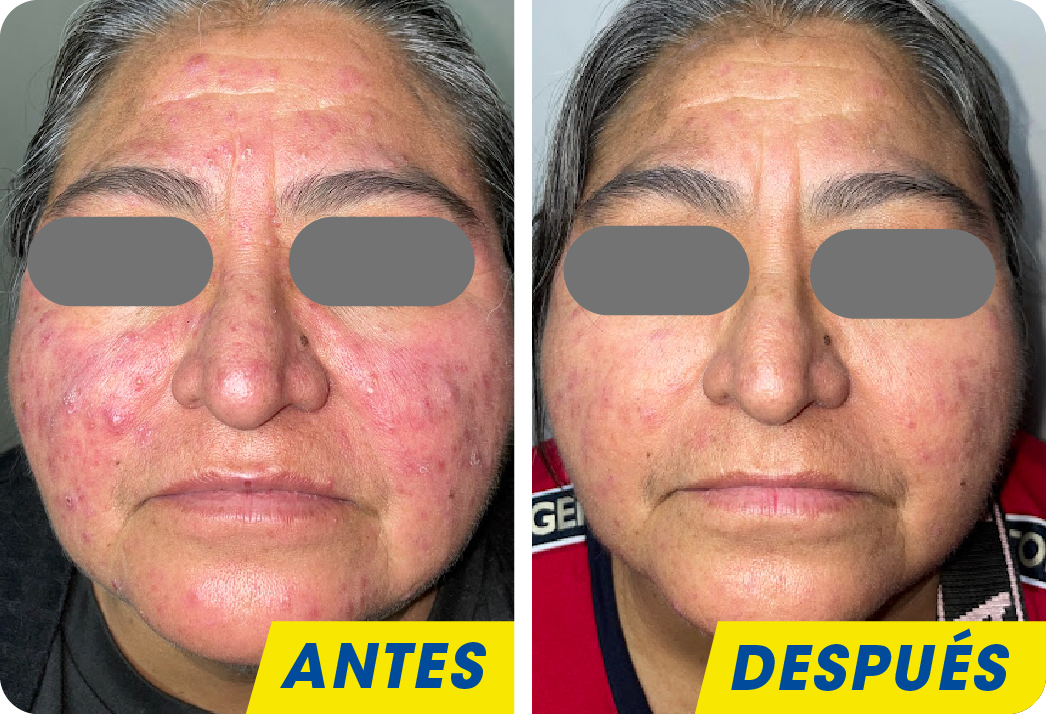 ROSACEA