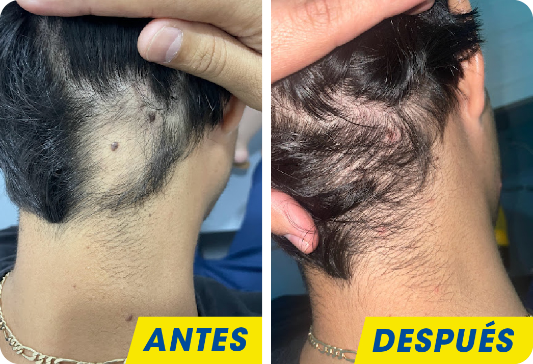 ALOPECIA